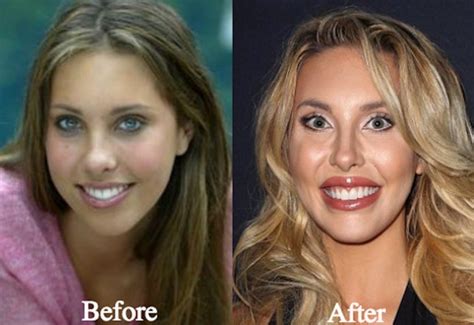 chloe lattanzi before surgery